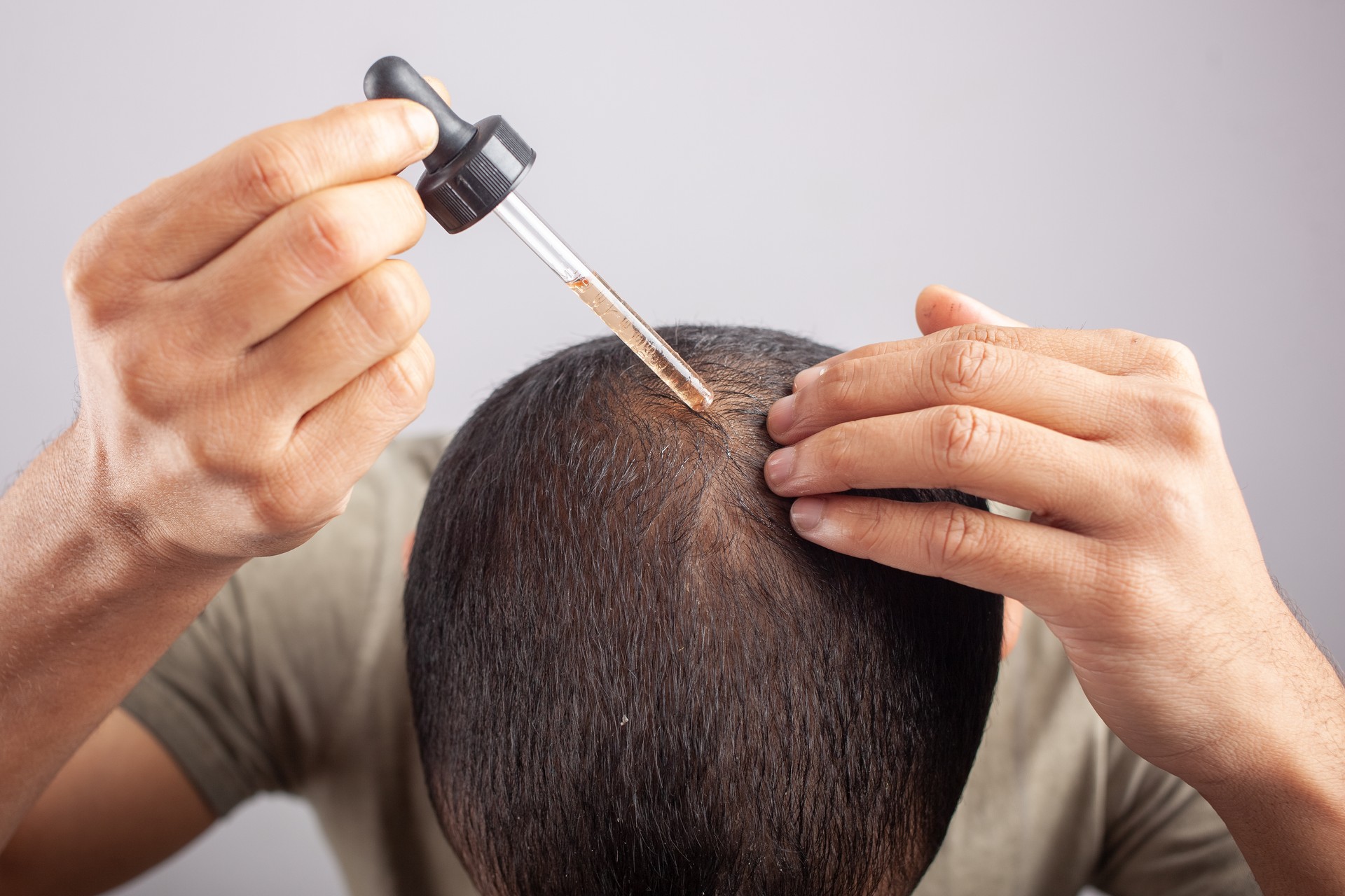 man using My BAE Root oil on bald scalp to treat hair loss